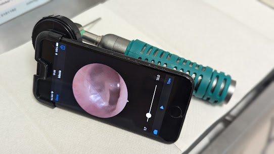 Endoscope camera view of an ear during earwax removal at BestHear Swansea